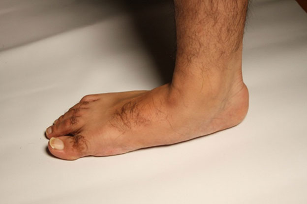 چند روش مفید برای درمان بیماری صافی کف پا | آشنایی با بیماری صافی کف پا