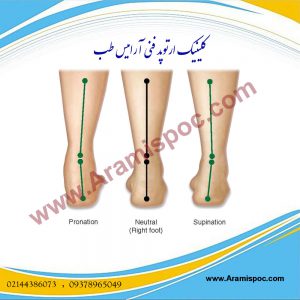 درمان صافی کف پا بدون جراحی