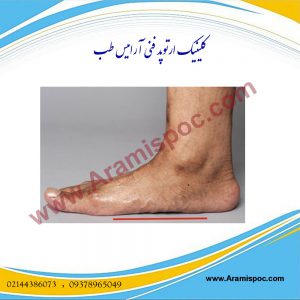 درمان صافی کف پا بدون عمل جراحی